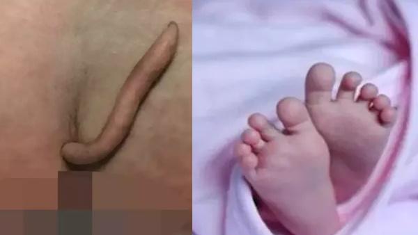 baby girl: इस बच्ची ने 6 सेमी की पूूंछ के साथ लिया जन्म