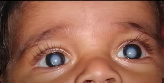 Eye Care : बच्चों में बढ़ रहा मोतियाबिंद, 15% में अंधता का है कारण