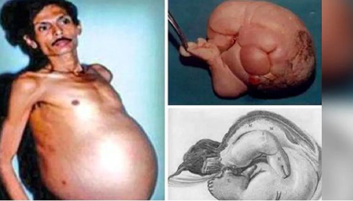 Pregnant Man: डॉक्टरों ने ट्यूमर समझ किया ऑपरेशन तो मर्द के पेट से निकले जुड़वा बच्चे !