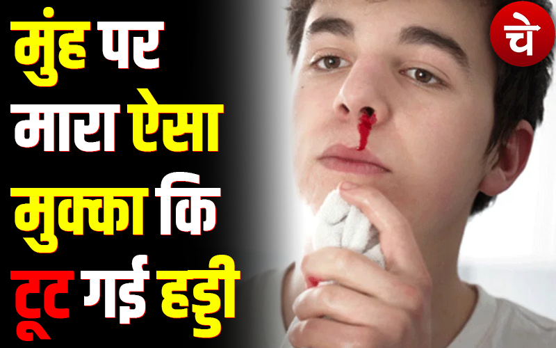 Noida News : रोडरेज : मुंह पर मारा ऐसा मुक्का कि टूट गई हड्डी